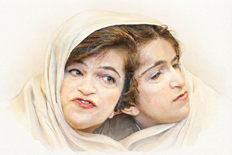 دو فرد چسبیده از بدو تولد